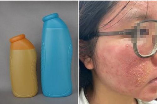 Cô gái 25 tuổi ngứa rát mặt sau khi dùng mỹ phẩm được bạn trai tặng dịp Valentine