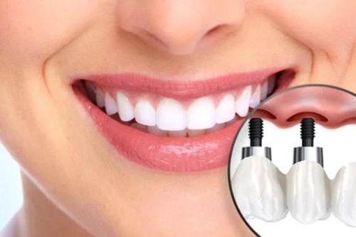 Đánh giá chân thực trải nghiệm trồng răng Implant