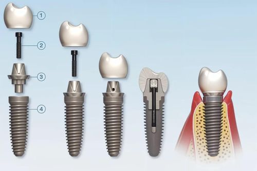 Giải đáp thắc mắc tại sao trồng răng Implant có chi phí cao?