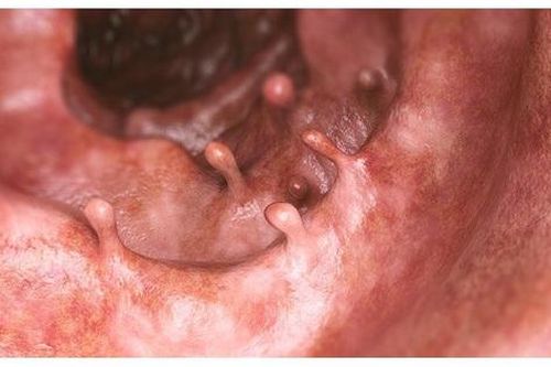 Polyp đại tràng có phải cắt không?