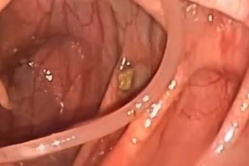 Các thói quen khiến bạn dễ mắc giun đũa và cách phòng ngừa