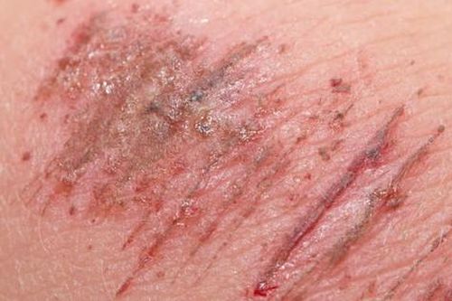 Liên tiếp 2 trường hợp nhiễm khuẩn tụ cầu vàng từ vết xước và nốt mụn nhỏ trên mặt