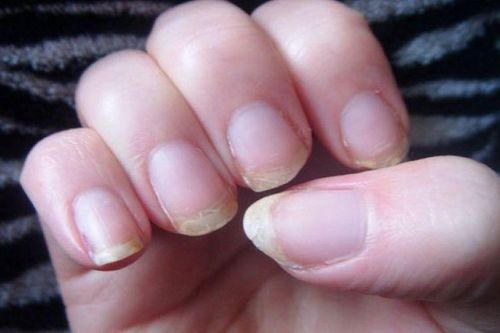 5 dấu hiệu phổ biến cảnh báo thiếu hụt vitamin và khoáng chất thiết yếu