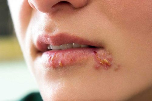 Cách trị giời leo ở miệng hiệu quả