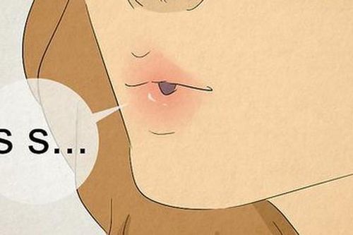 Bài tập giúp người bị liệt cơ mở thanh quản nói rõ ràng hơn