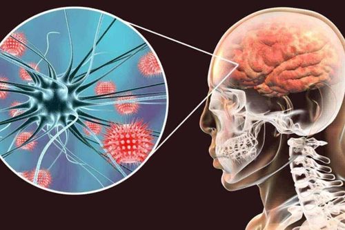 Nguy hiểm bệnh viêm não mô cầu
