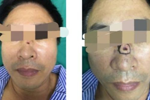 Tự hào nốt ruồi phong thủy, đến bệnh viện mới hay là dấu hiệu ung thư