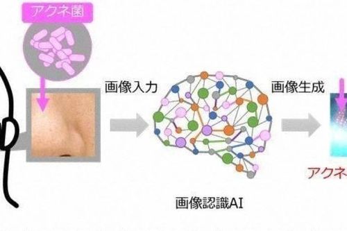 Ứng dụng công nghệ AI phát hiện vi khuẩn gây mụn trứng cá
