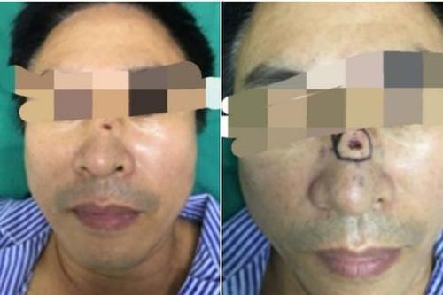 Người đàn ông tự hào nốt ruồi ở sống mũi 'phong thủy tốt', đi khám tá hỏa mắc ung thư