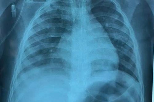 Bé gái đông đặc phổi do mắc cúm A