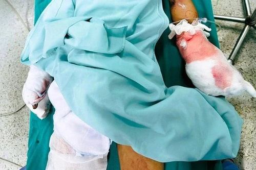 Tự chế pháo, học sinh lớp 6 ở Thanh Hóa bị dập nát bàn tay
