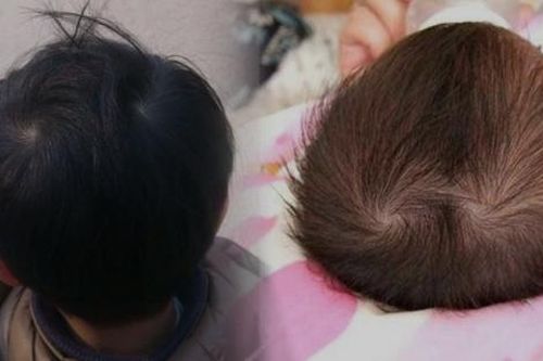 Xoáy tóc trên đầu liên quan thế nào đến IQ của trẻ?