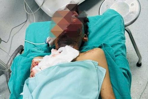 Học sinh lớp 6 bị nát bàn tay do chế tạo pháo