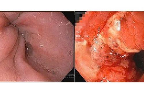 Những dấu hiệu 'âm thầm' gây ung thư dạ dày