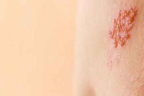 Thuốc điều trị đau và sẹo do zona thần kinh
