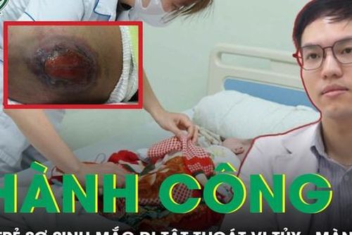 Cứu sống trẻ sơ sinh mắc dị tật thoát vị tủy - màng tủy nguy kịch