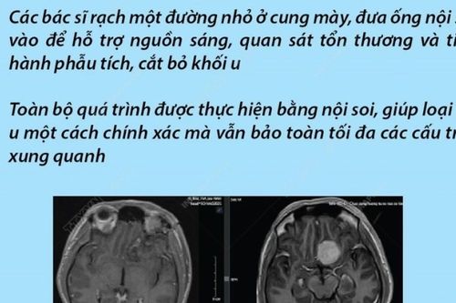 Lần đầu tiên phẫu thuật cắt bỏ khối u não qua vết mổ nội soi trên cung mày