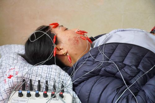Cảnh báo liệt mặt biến chứng do tự ý điều trị tại nhà