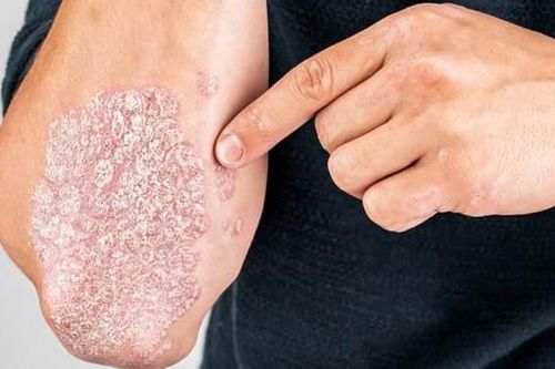 Các thuốc điều trị bệnh vảy nến