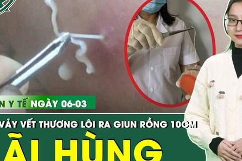 Bản Tin Y Tế 6/3: Cạy vảy vết thương, người đàn ông hãi hùng lôi ra con giun rồng dài 10cm
