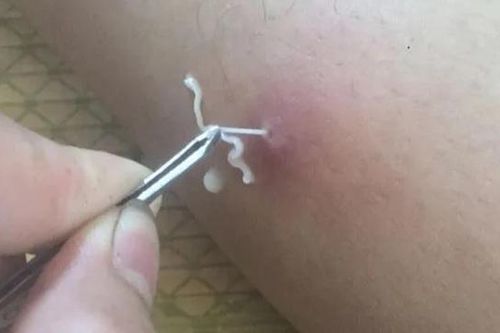 Giám sát ca bệnh nhiễm giun rồng tại Hòa Bình