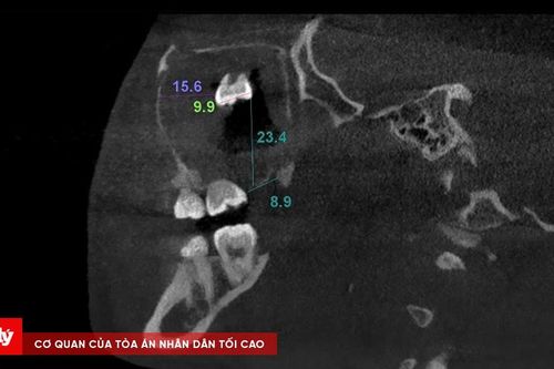 Phẫu thuật thành công lấy răng khôn ngầm trong xoang hàm hiếm gặp