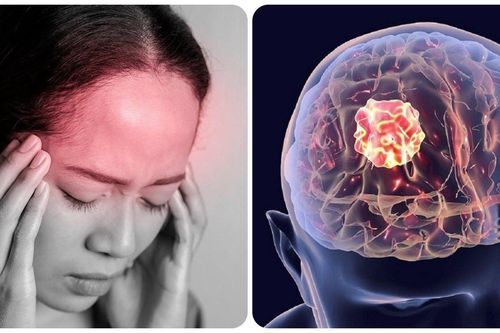 Ung thư não có những triệu chứng gì?