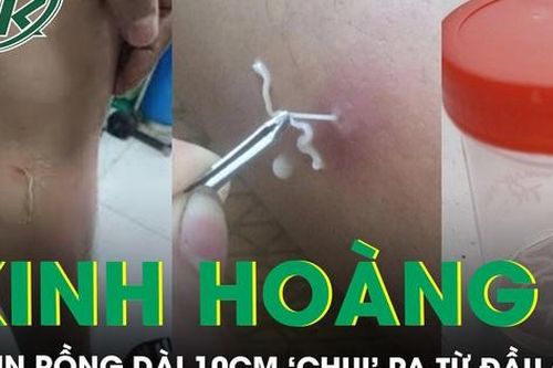 Kinh hoàng giun rồng dài 10cm 'chui' ra từ đầu gối