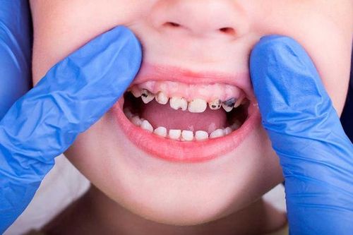 Chỉ vì một hiểu lầm về răng sữa, mẹ vô tình khiến con dễ bị sâu sún răng mà không hay