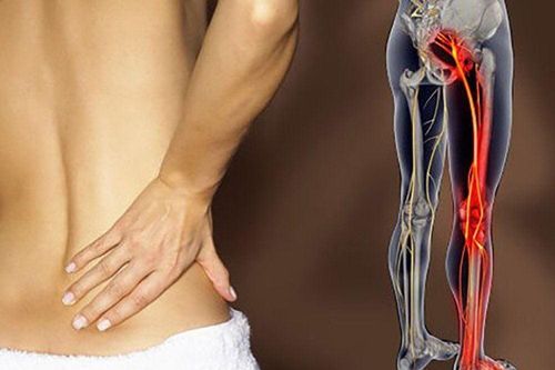 4 lưu ý giúp giảm đau thần kinh tọa