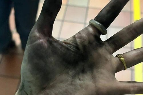 Cục sạc dự phòng bất ngờ phát nổ, người phụ nữ hoảng hồn khi nhìn xuống bàn tay mình