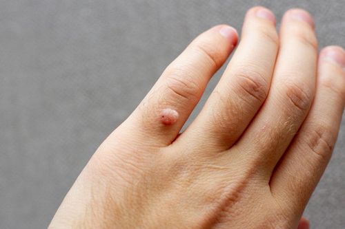 Dấu hiệu trên da cảnh báo bệnh truyền nhiễm nguy hiểm