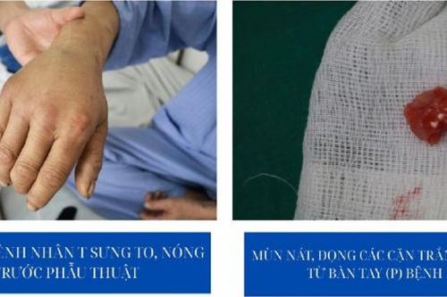 Đứt gân, nhiễm trùng cổ tay sau 4 mũi tiêm khớp của 'thần y'
