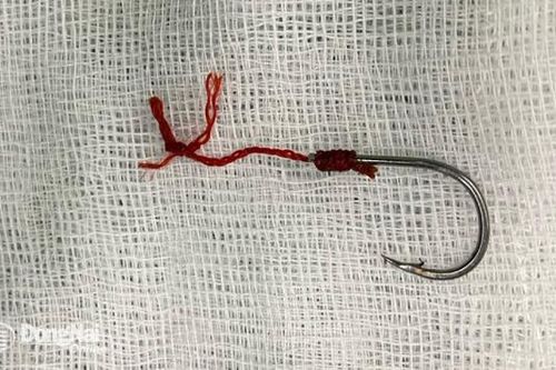 Hi hữu: Mổ cấp cứu lấy móc câu trong hậu môn cho bệnh nhân 40 tuổi ở Long Thành