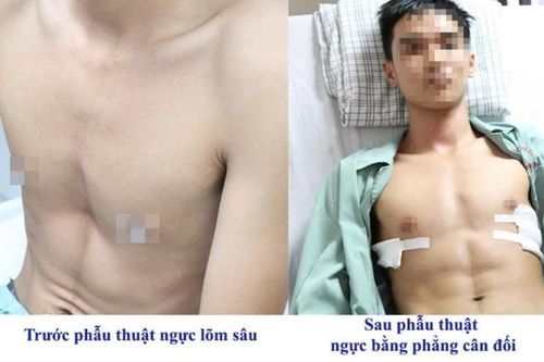 Chàng trai 19 tuổi vượt gần 2.000 km để chữa bệnh lõm ngực bẩm sinh, kết quả ngoài sự mong đợi