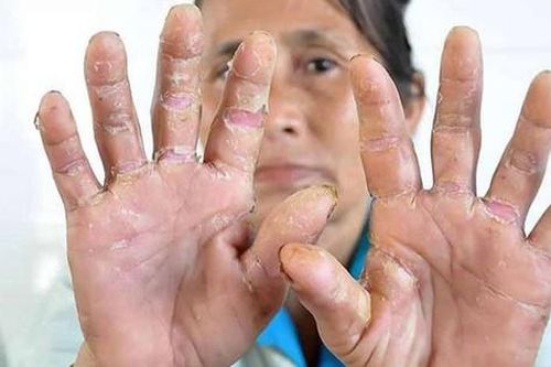 Các thuốc điều trị bệnh á sừng