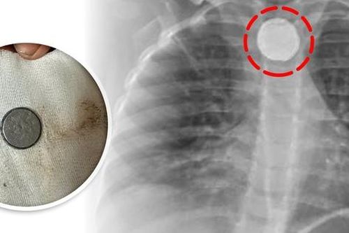 Gắp viên pin đường kính 2cm trong thực quản bé 30 tháng tuổi