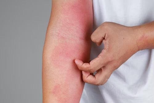 Nguyên nhân khiến da thường xuyên bị khô, ngứa