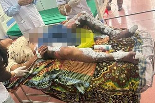 Điện thoại để trong túi quần phát nổ, nam thanh niên bỏng nặng vùng kín