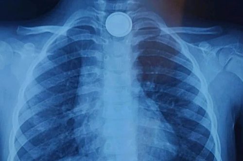 Hà Nội: Bệnh nhi 4 tuổi loét thực quản vì nuốt phải pin cúc áo
