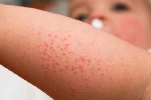 Bộ Y tế thông tin về việc hàng trăm trẻ sốt phát ban tại Quảng Nam
