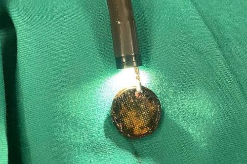 Bé gái 4 tuổi gặp nguy hiểm do nuốt phải pin cúc áo, bác sĩ khuyến cáo việc nên làm để ngăn ngừa tai nạn cho trẻ
