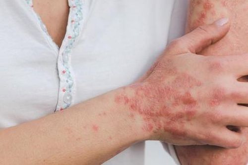 Thuốc điều trị vảy nến ở phụ nữ mang thai và cho con bú