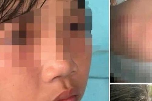 Đình chỉ học tập nữ sinh lớp 6 đánh bạn gây thương tích