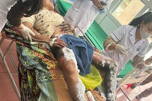 Người đàn ông bị bỏng nặng vùng kín nghi do điện thoại phát nổ
