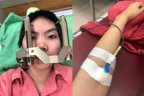 Đột quỵ khi còn trẻ vì lao lực, làm việc không ngừng nghỉ