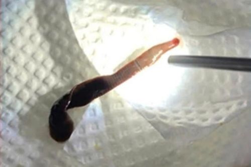 Gắp con vắt dài 8cm sống trong mũi người phụ nữ