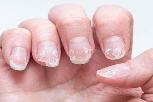 Có thể bạn đang thiếu hụt vitamin B12 nếu móng tay có những dấu hiệu này