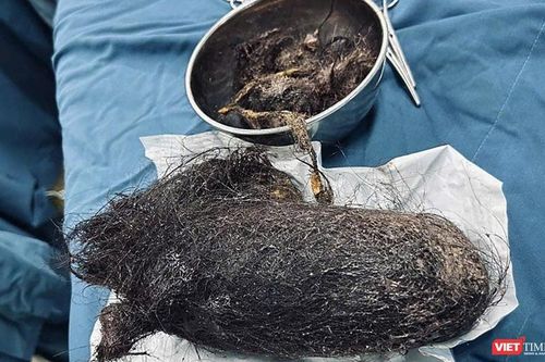Bóc bỏ búi tóc khổng lồ nặng gần 1kg trong dạ dày bé gái 12 tuổi