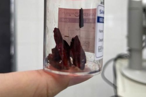 Mảnh gỗ dài nằm trong hốc mắt nam thanh niên suốt 1 tháng